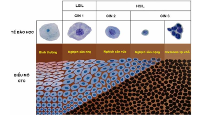Hình 2. Sự tương ứng giữa các hệ thống đánh giá tổn thương tiền ung thư CTC