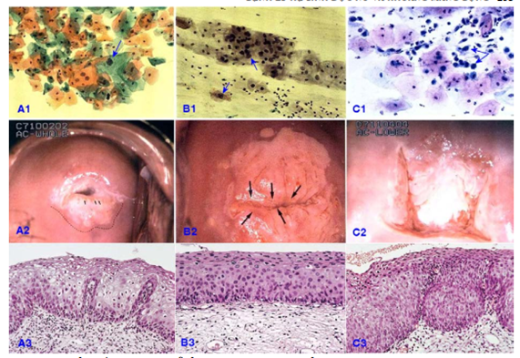 Hình 3. Hình ảnh tế bào học, soi cổ tử cung và mô bệnh học của LSIL/CIN 1 (A1, A2, A3); HSIL/CIN 2 (B1, B2, B3); HSIL/CIN 3 (C1, C2, C3)
