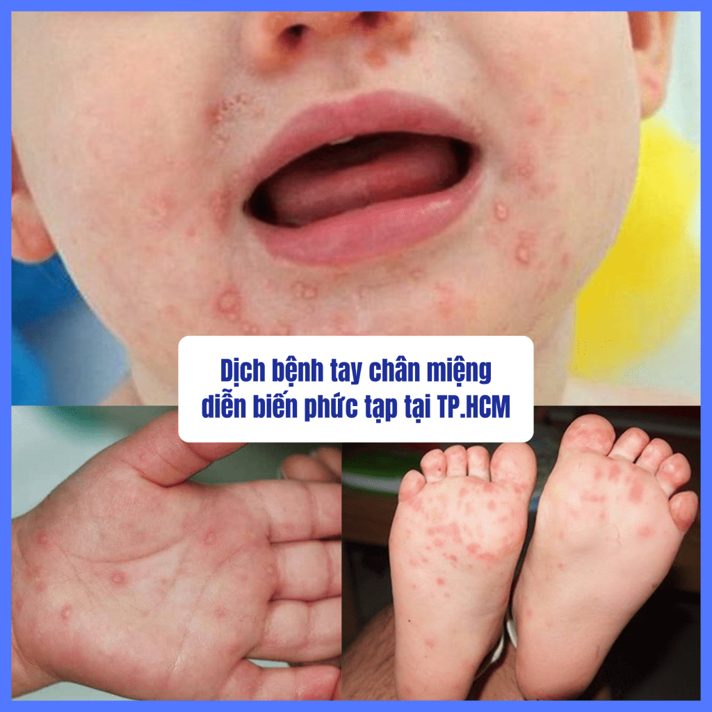 Biểu hiện bệnh tay chân miệng 